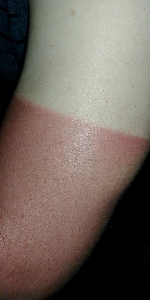 sunburn