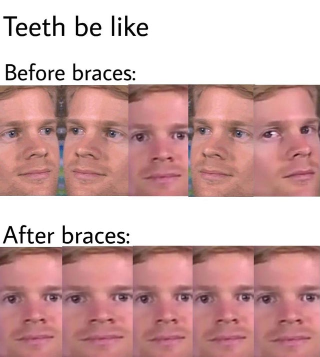 Internet meme - Teeth be Before braces After braces