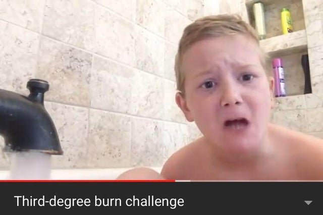 4th degree burns - Thirddegree burn challenge