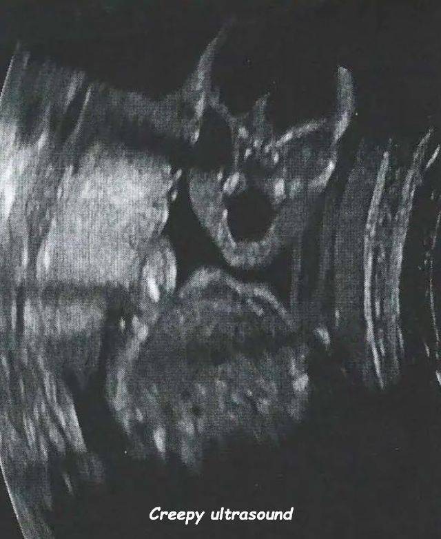 scariest picture ever taken - M Creepy ultrasound