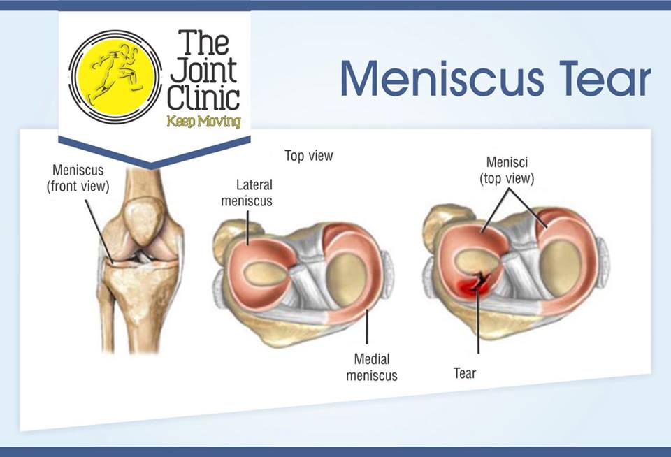 Anterior Cruciate Ligament (ACL) is an important ligament which holds together the thigh bone and shin bone at the center of the knee joint. It is often torn during sports injuries, road accidents or other twisting knee injuries. People suffering from torn Anterior Cruciate Ligament(ACL) feel instability and insecurity in the knee while walking/run