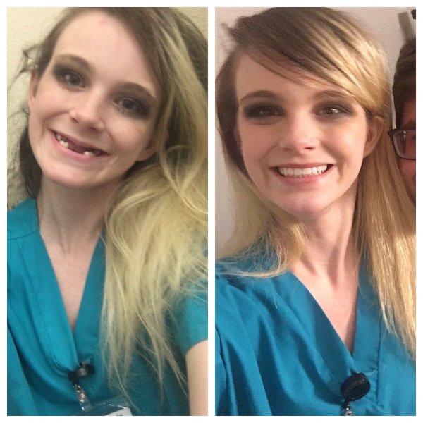 “I went through Bulimia recovery and here is me after my teeth restoration.”