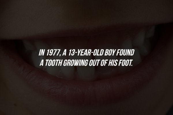lip - In 1977, A 13YearOld Boy Found A Tooth Growing Out Of His Foot.