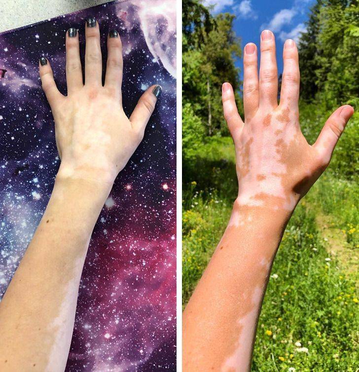 “How my vitiligo changes from winter to summer”