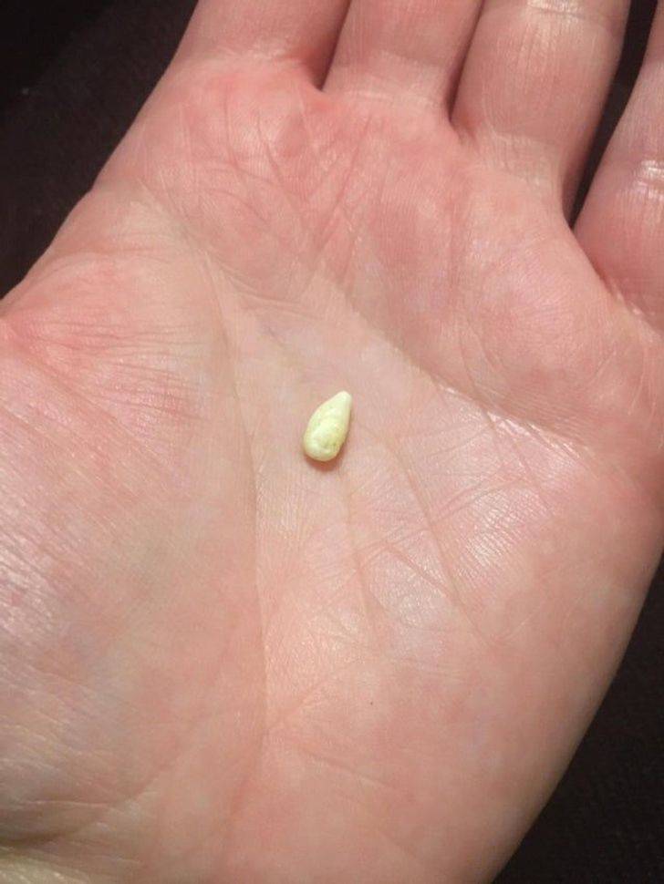“This tooth bud that was growing in the roof of my mouth”