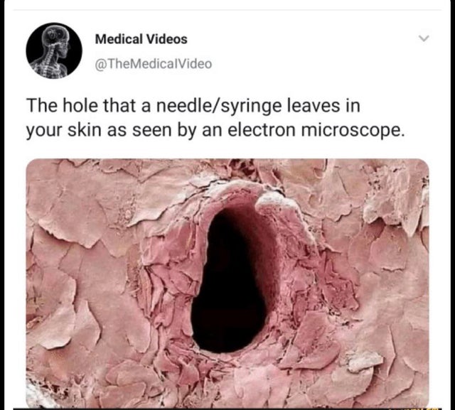 needle hole under microscope - Medical Videos @ The Medical Video The hole that a needlesyringe leaves in your skin as seen by an electron microscope.