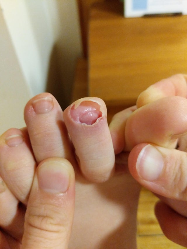 This is what it would look like if you didn't have a toenail. That's what your toe interior looks like, just waiting for its chance to emerge.