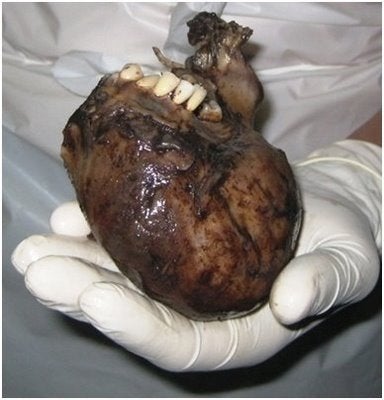 Speaking of gross hair things, this is a teratoma. A teratoma is a tumor that reproduces several distinct types of tissue, like hair, teeth, and even eyes! Who knows - you might have one of these inside you right now!