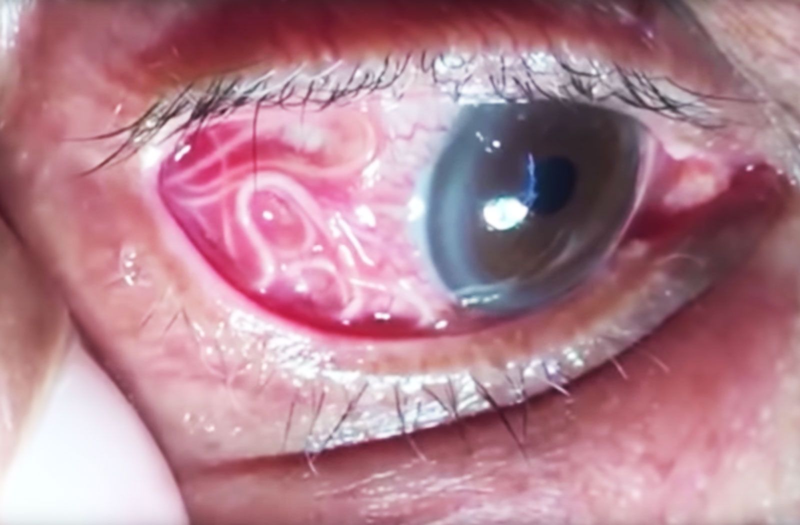 scary things  - roundworm eye