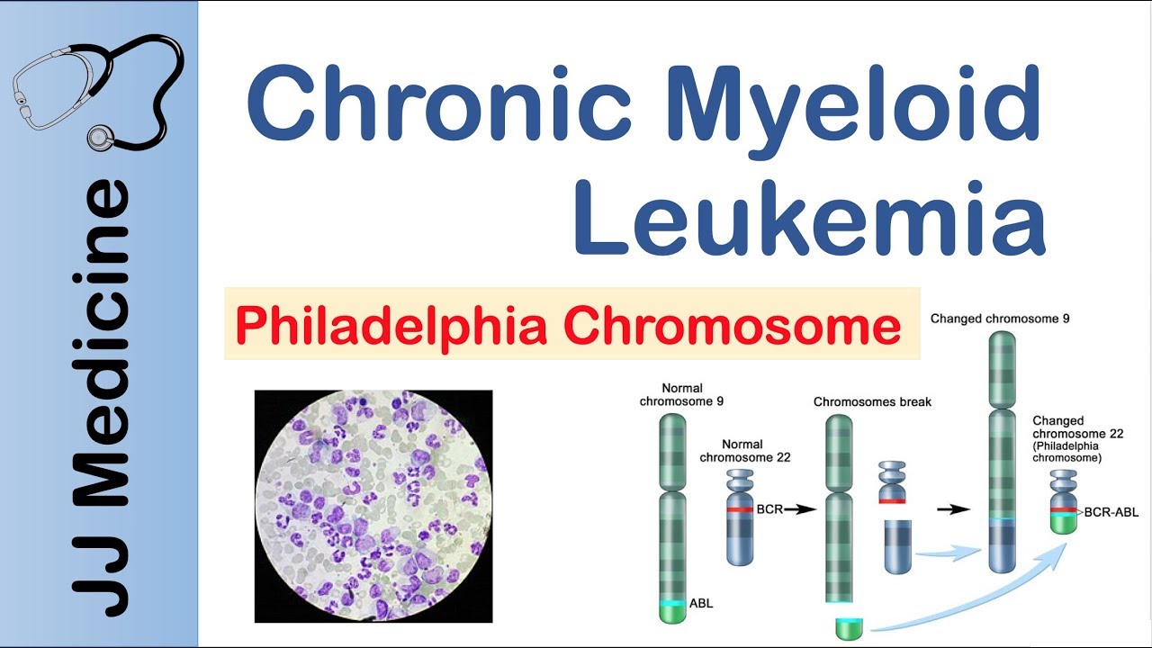 chronic myeloid leukemia - Chronic Myeloid Leukemia Changed chromosome 9 Philadelphia Chromosome Jj Medicine Normal chromosome 9 Chromosomes break Normal chromosome 22 Changed chromosome 22 Philadelphia chromosome Bcr BcrAbl Abl