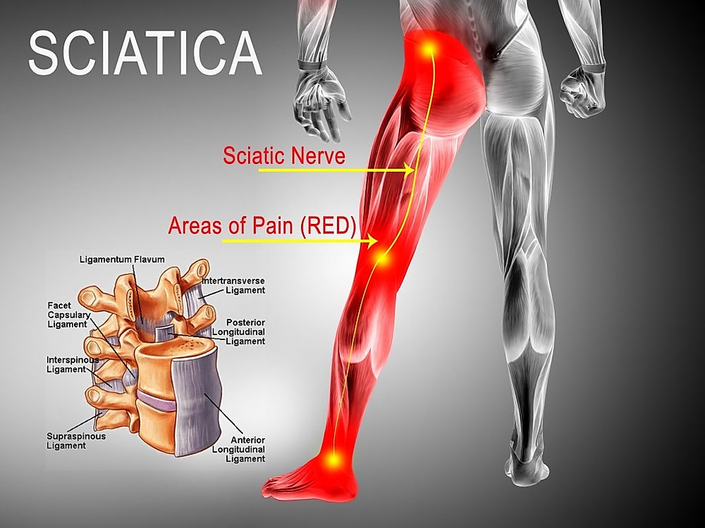 poorly designed body parts - sciatic nerve routing