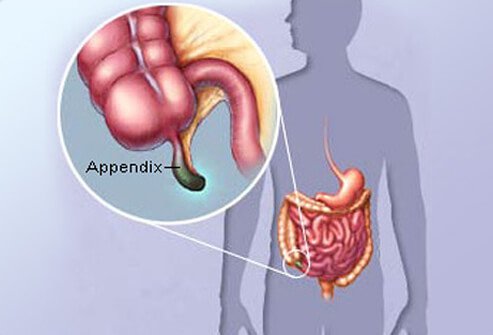 poorly designed body parts - appendixes