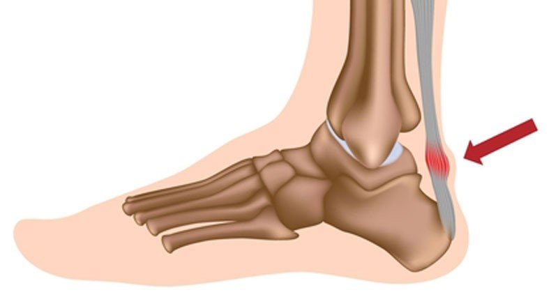 poorly designed body parts - Achilles tendon
