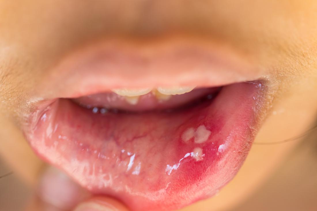 scary science facts - herpes mouth sore