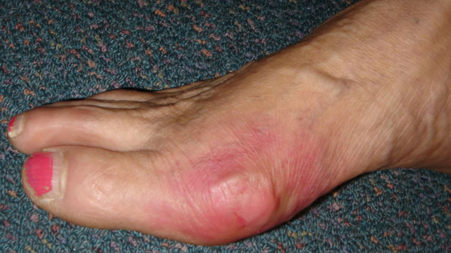 World’s Most Painful Experiences - It’s a tie between gallstones and gout