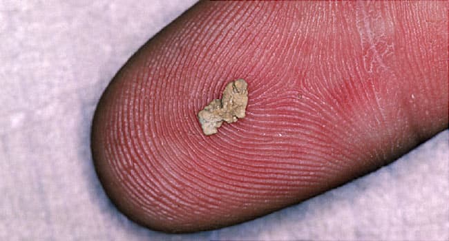 World’s Most Painful Experiences - Kidney stone. 6mm. Peed it out