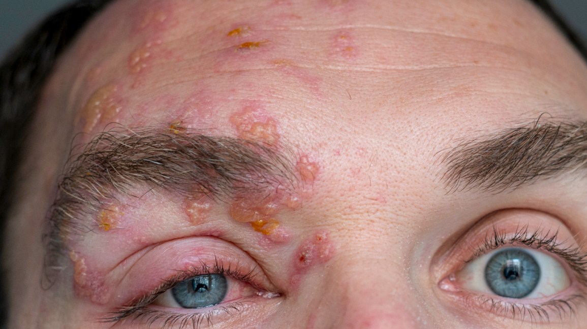 World’s Most Painful Experiences - Shingles