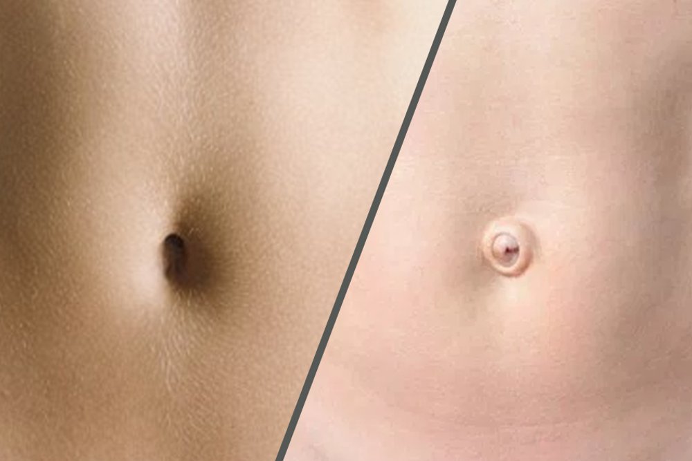 false facts -  - innie vs outie belly button cause