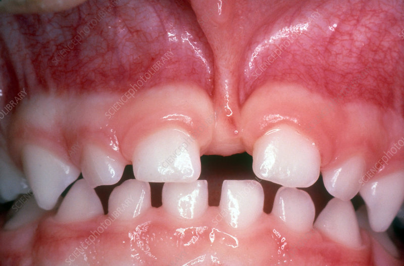 bigger isn't better - Gap between the teeth