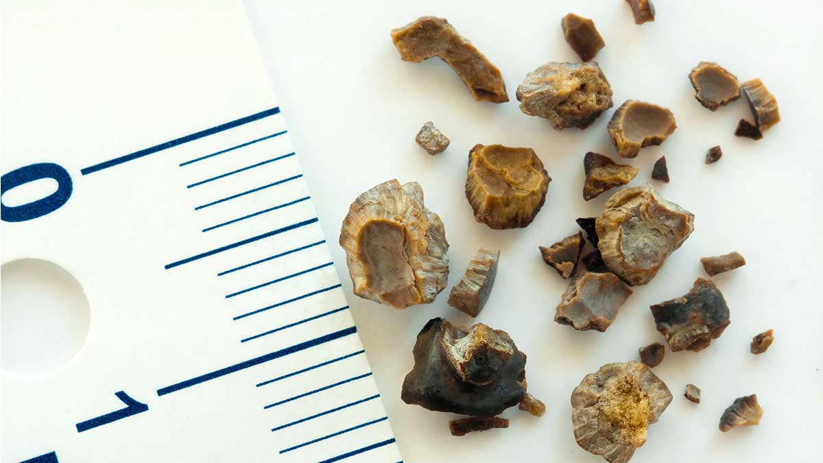 bigger isn't better - Kidney stones