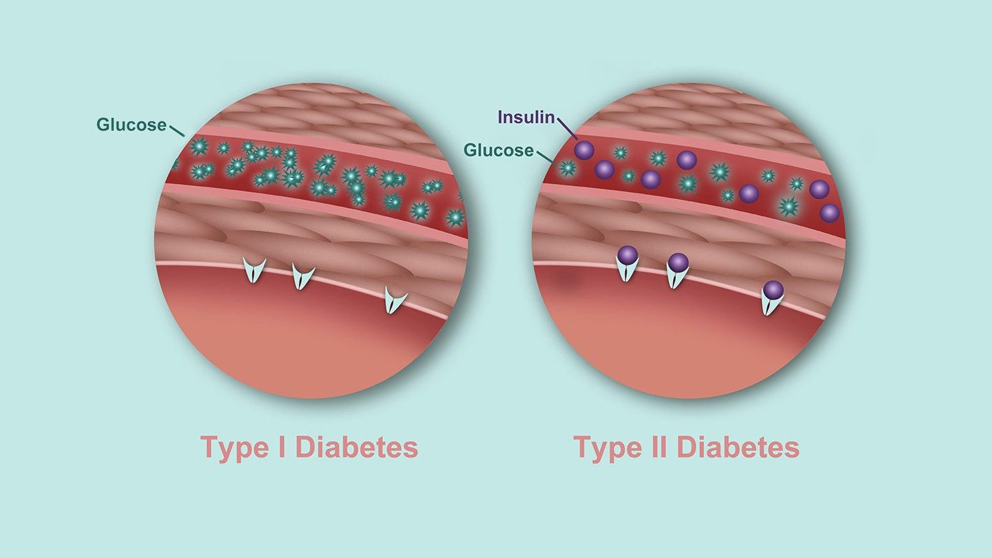 tired of explaining - The difference between type 1 and type 2 diabetes.