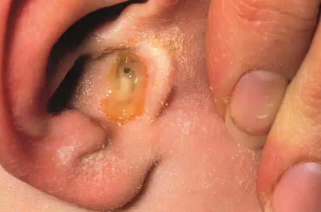 An ear infection left untreated can grow and sit for years on end, slowly eating away at your ear canal. If untreated long enough the erosion causes dead skin cells in your ear unable to escape so they build up into a benign cyst called a cholesteatoma. Left untreated this can grow and affect balance, facial movement and eventually lead to deathly infection. -u/cohen63