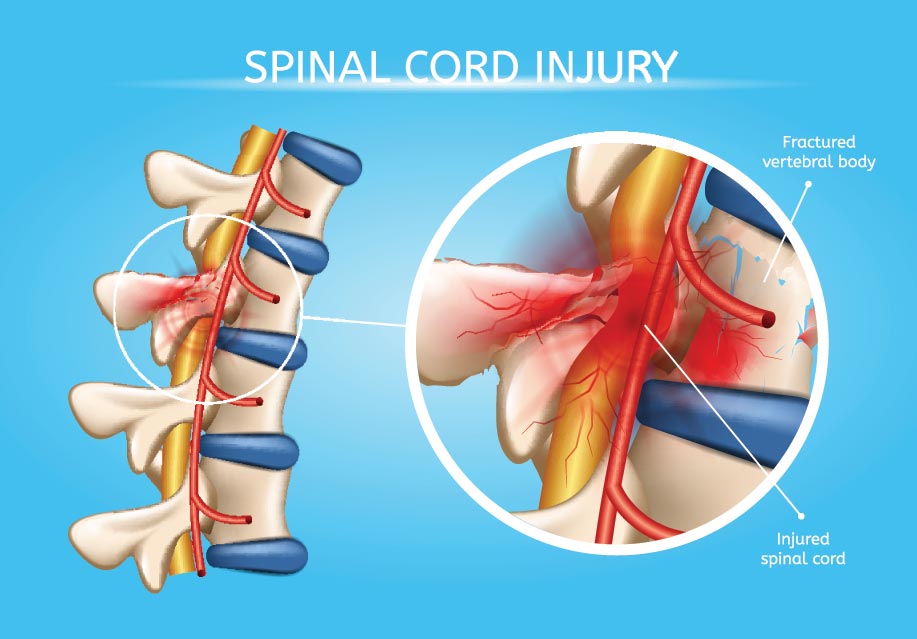 depressing facts - spinal cord injury symptoms - Spinal Cord Injury Fractured vertebral body Injured spinal cord