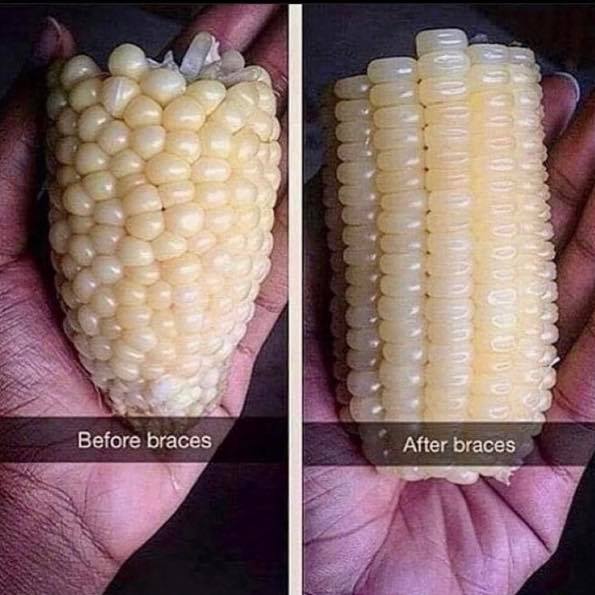 corn braces - Domus Us Before braces After braces