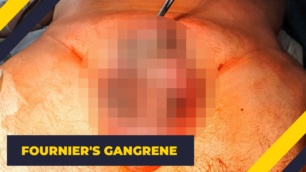 orange - Fournier'S Gangrene