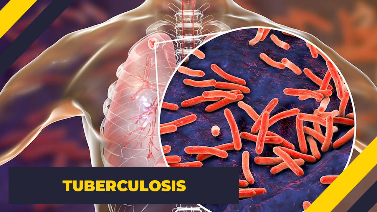 mycobacterium tuberculosis - Tuberculosis