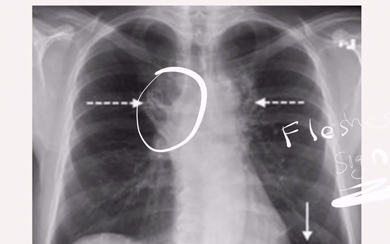 scariest moment - pulmonary embolism chest x ray - Flesh sig