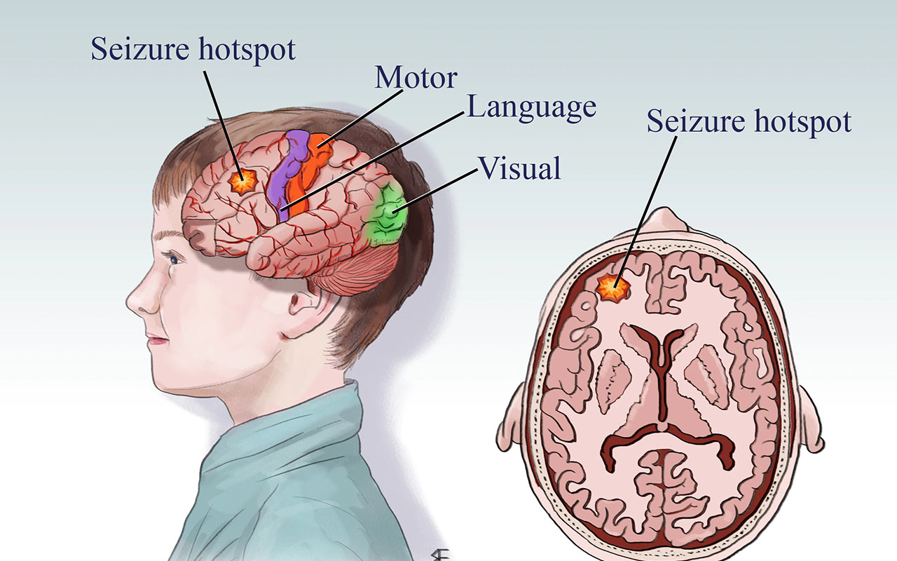scariest moment - epilepsy disease - Seizure hotspot Motor Language Seizure hotspot Visual 4