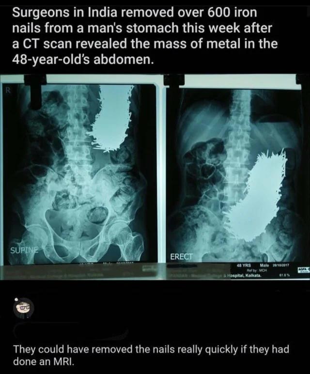 cursed comments - without any milk meme - Surgeons in India removed over 600 iron nails from a man's stomach this week after a Ct scan revealed the mass of metal in the 48yearold's abdomen. R Supine Erect 48 Yrs Male 29102017 Refby Mch & Hospital, Kolkata