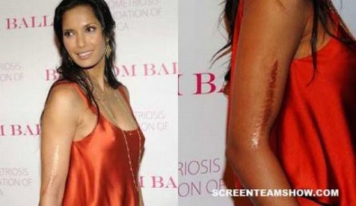Celebrities and Their Physical Defects