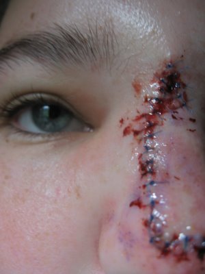 Girl gets some pretty nasty stitches on her nose