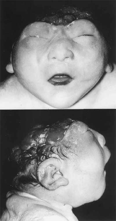 An infant with a cephalic disorder known as Anencephaly. Infants with this defect have no brain, or sometimes have only a brain-stem, and generally are missing the top of their skull. They are unconscious of the world around them and can't feel pain.