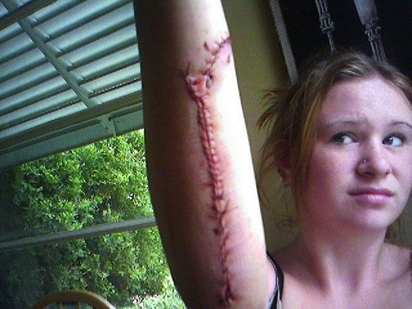 My friend Ashley fell through a window and drunk. These were her first stitches. From Oak Lawn, Illinois.