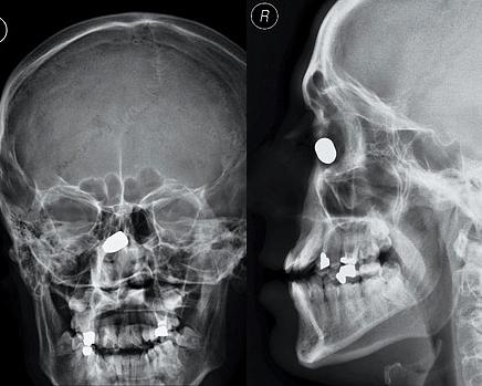 This poor guy was shot in the face at close range, but his nose stopped the bullet, saving his life