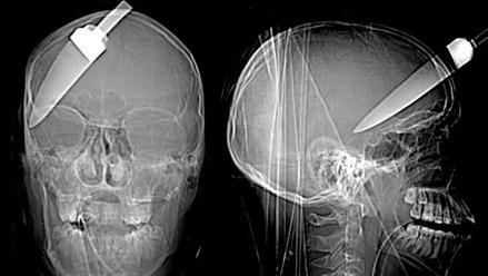 These X-ray images show a teenage boy with a 5-inch knife was plunged into his head.