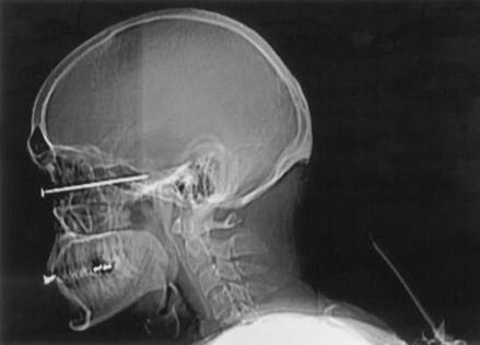 This X-ray shows a 3-inch nail in the head of a Houston carpenter.