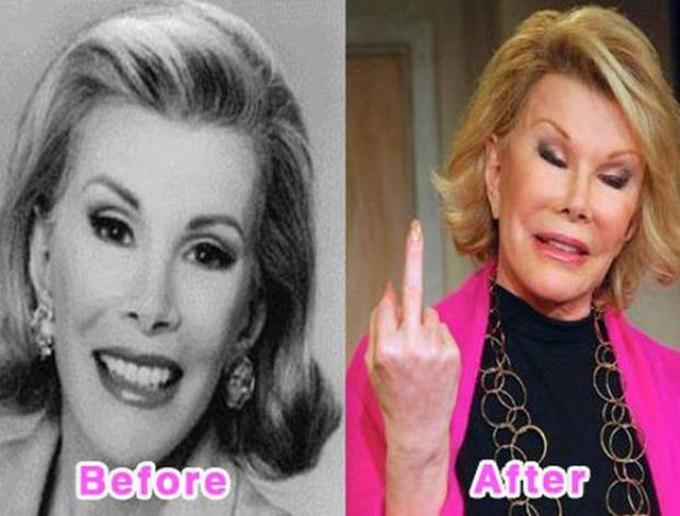 Celebrities Before and After Plastic Surgery