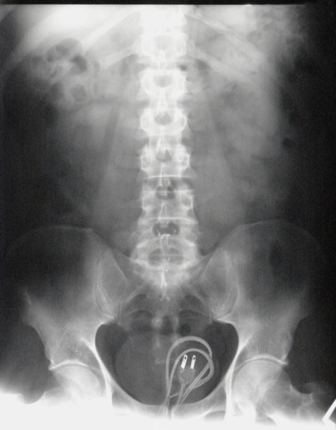 Stuck In You X-Rays