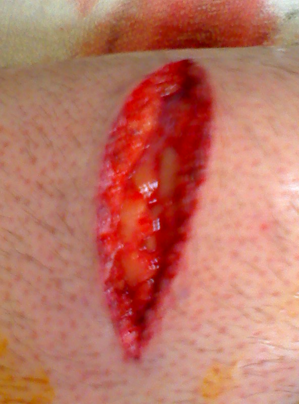 I cut my leg with a circular saw