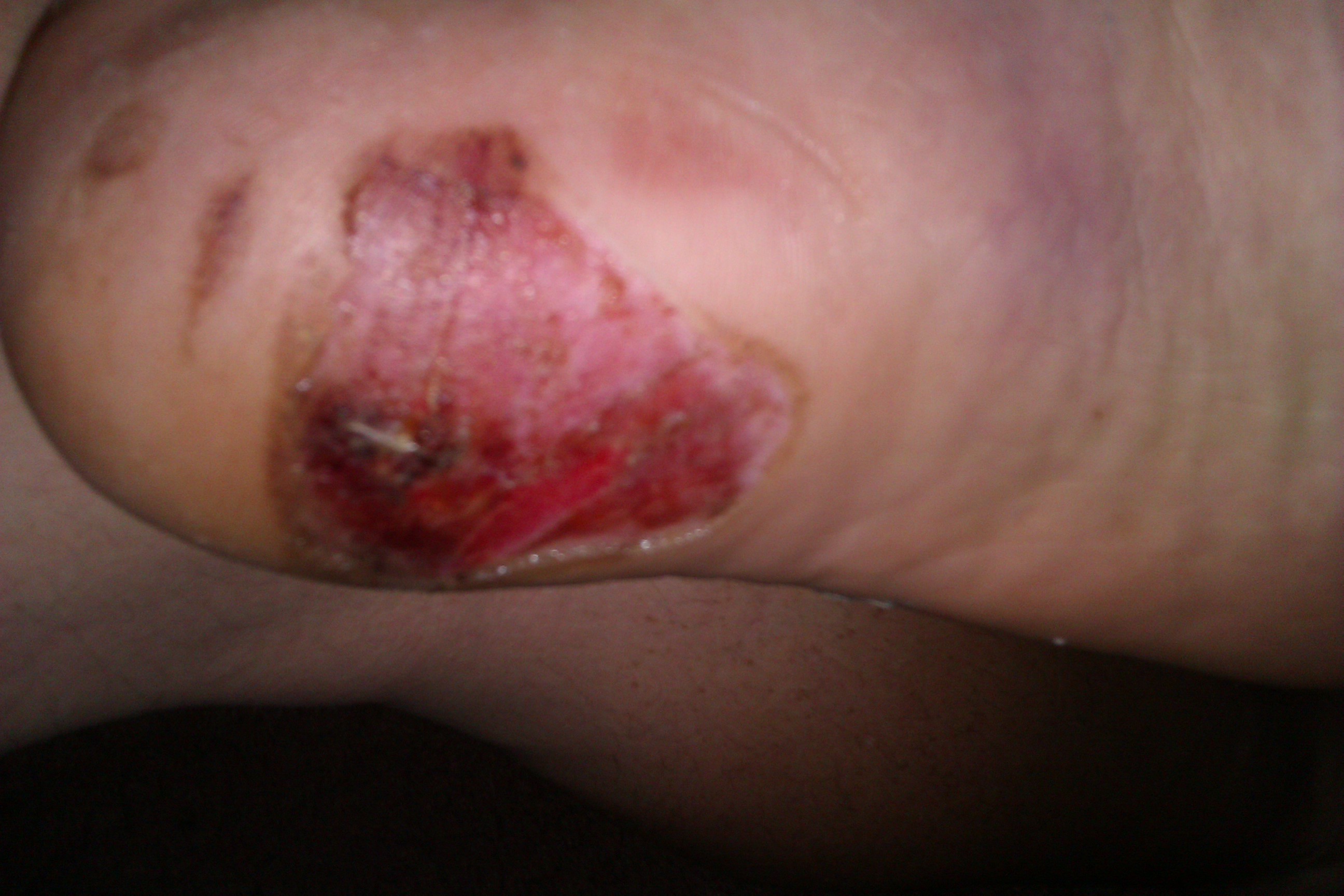 foot injury healing