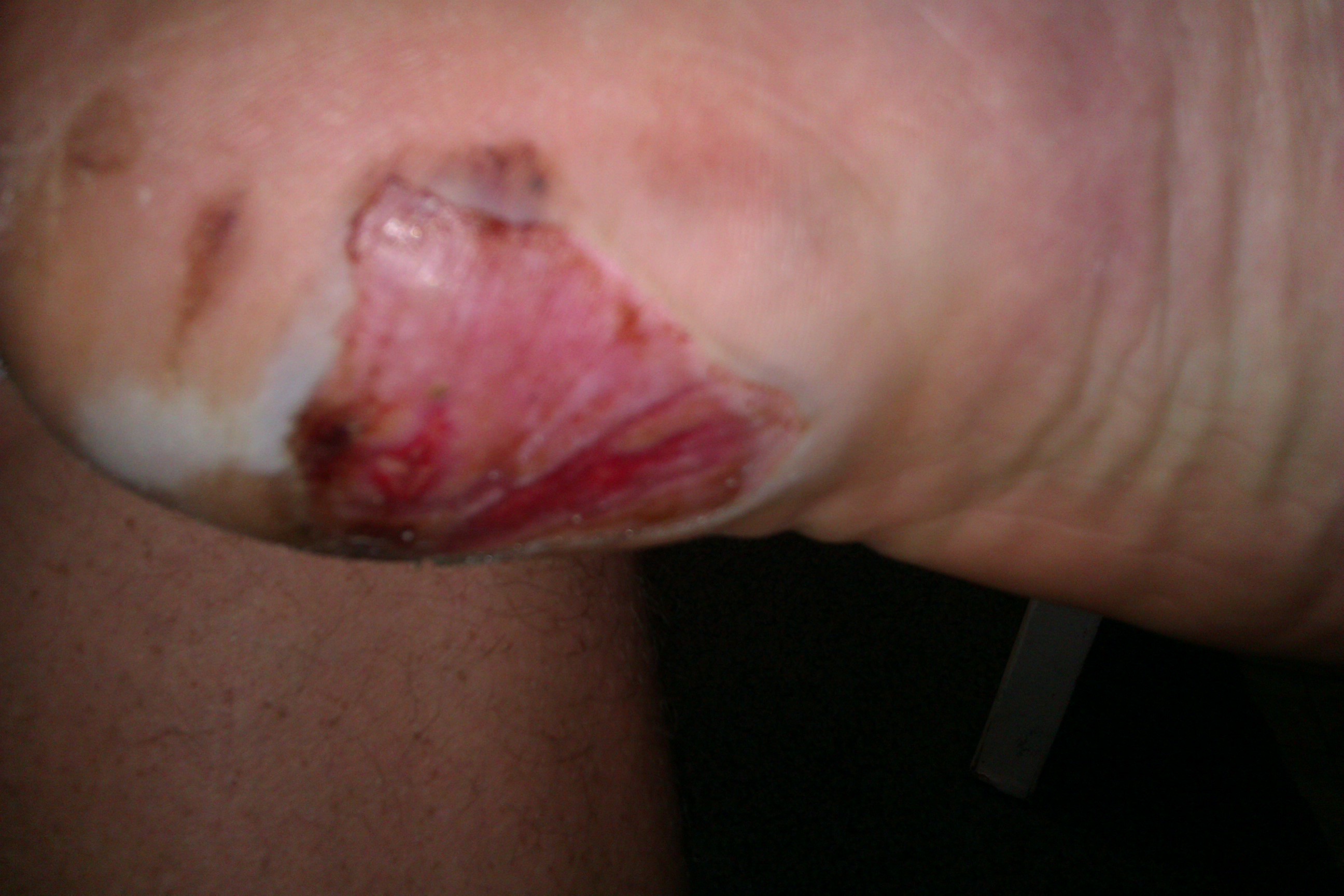 foot injury healing