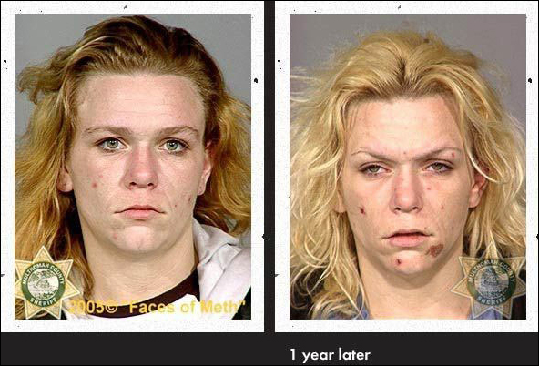 Meth Heads Before and After