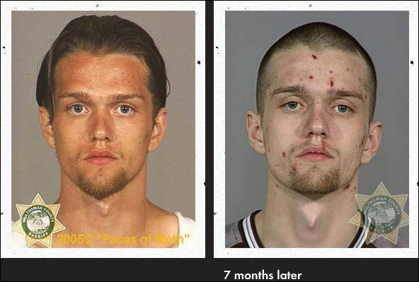 Meth Heads Before and After