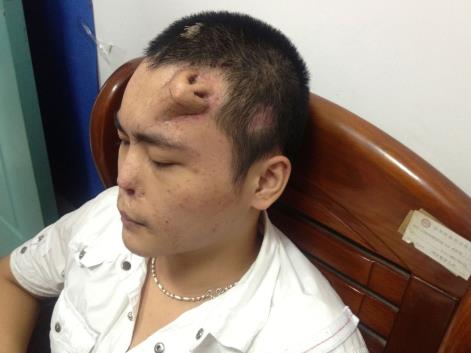 Man has new nose grown on his forehead, September 2013