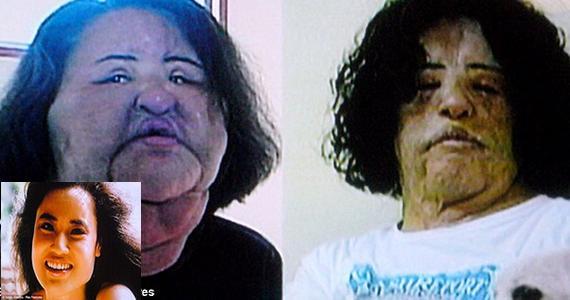 21 Disasters of Plastic Surgery