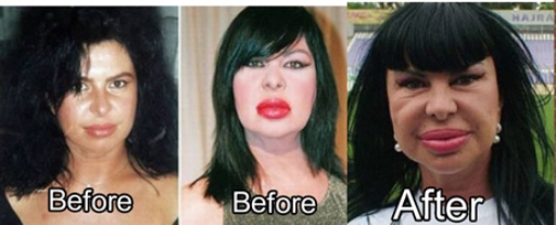 21 Disasters Of Plastic Surgery Gallery Ebaum S World